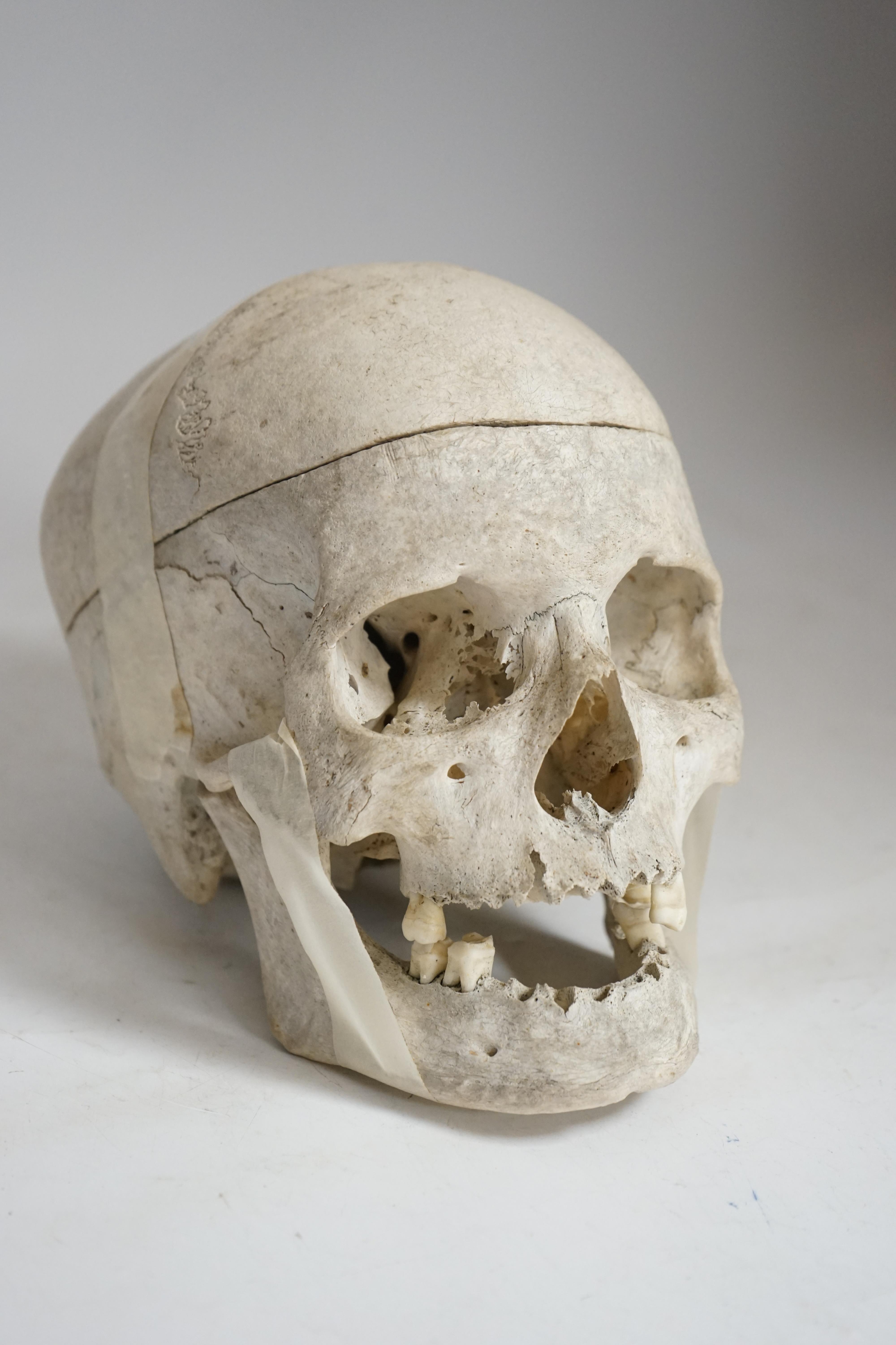 Human Anatomy - An Antique anatomical human skull, with lower jaw